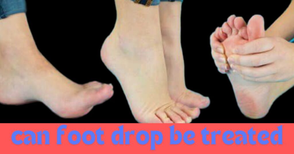 Foot Drop Kya Hai: जानें फुट ड्रॉप होने के कारण, लक्षण और पुनः अपने पैरो पर खड़ा के लिए 8 फुट ड्रॉप व्यायाम