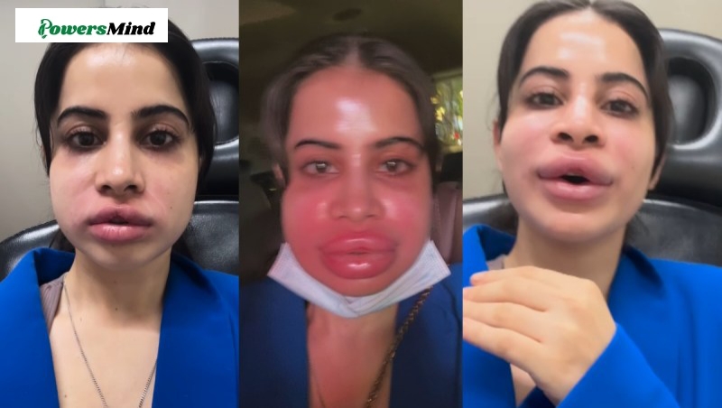 Urfi Javed Viral Video: कार्टून’ जैसी आखिर क्यों हो गई Urfi Javed की शक्ल, होठ मोटी ,सूजा चेहरा, बदला लुक देख फैंस रह गए हैरान!